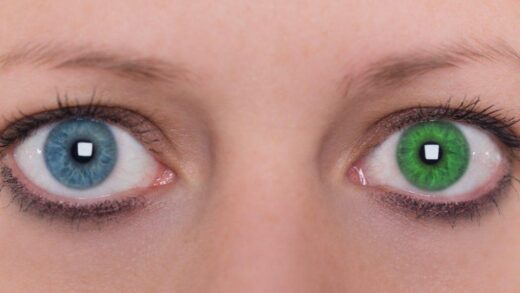 heterochromia - różnobarwność tęczówki