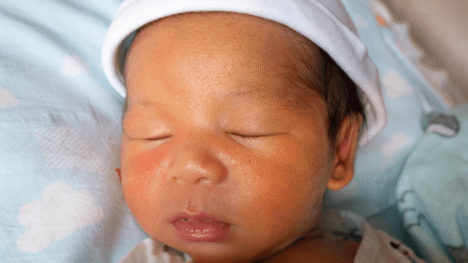 żółtaczka u noworodka