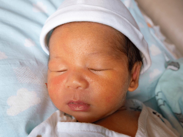 żółtaczka u noworodka